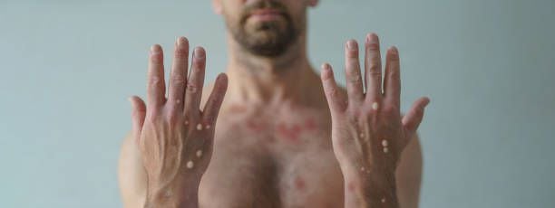 Imagen de archivo de una persona con Mpox. (iStock)