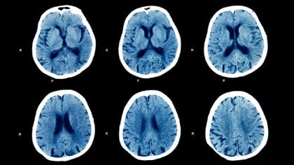 Se han informado secuelas neurológicas y psiquiátricas de COVID-19, pero se necesitan más datos para evaluar adecuadamente los efectos de COVID-19 en la salud cerebral (Shutterstock)