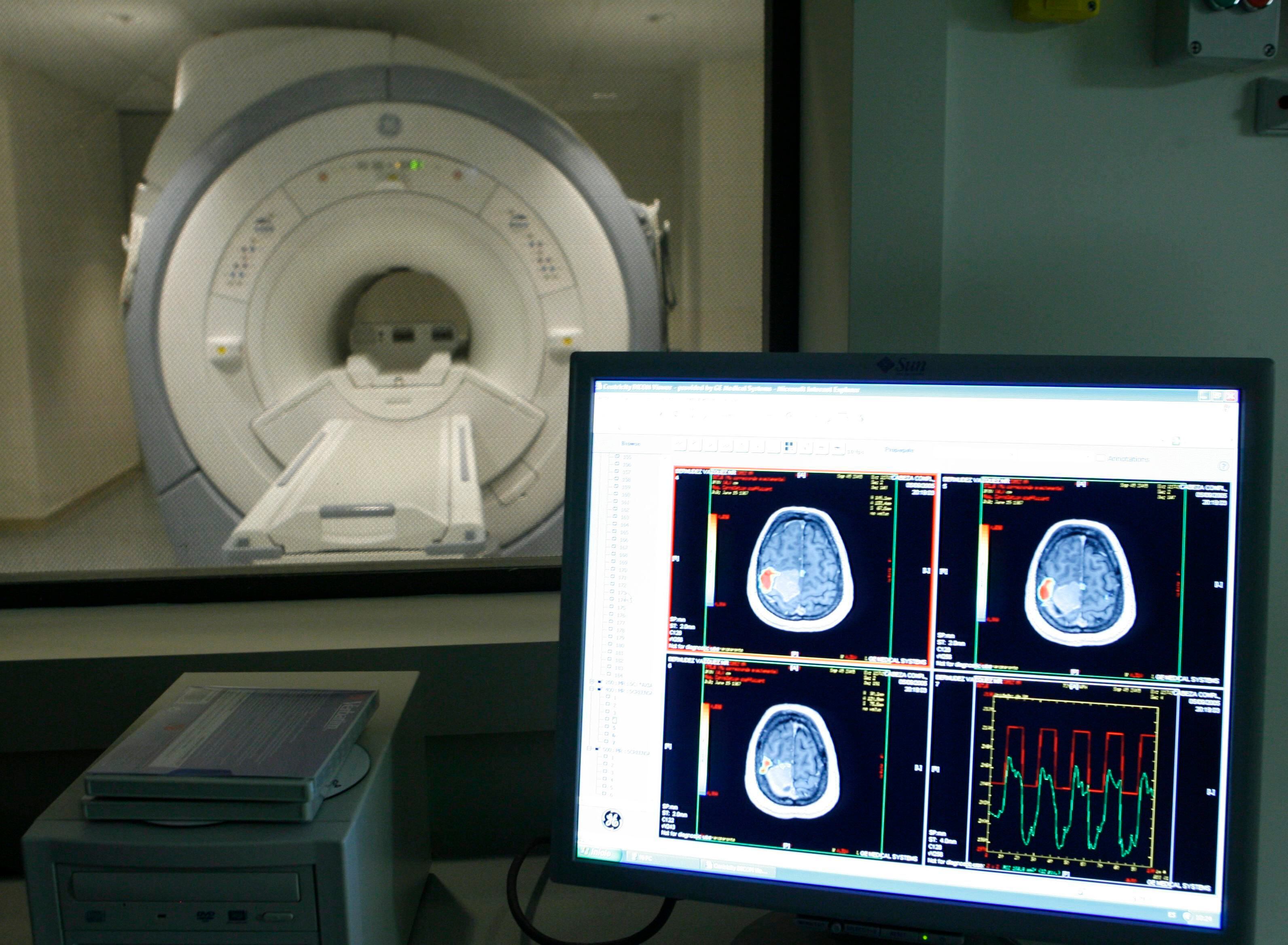 Descubren una nueva alteración en el cerebro de las personas con Alzheimer (EFE)
