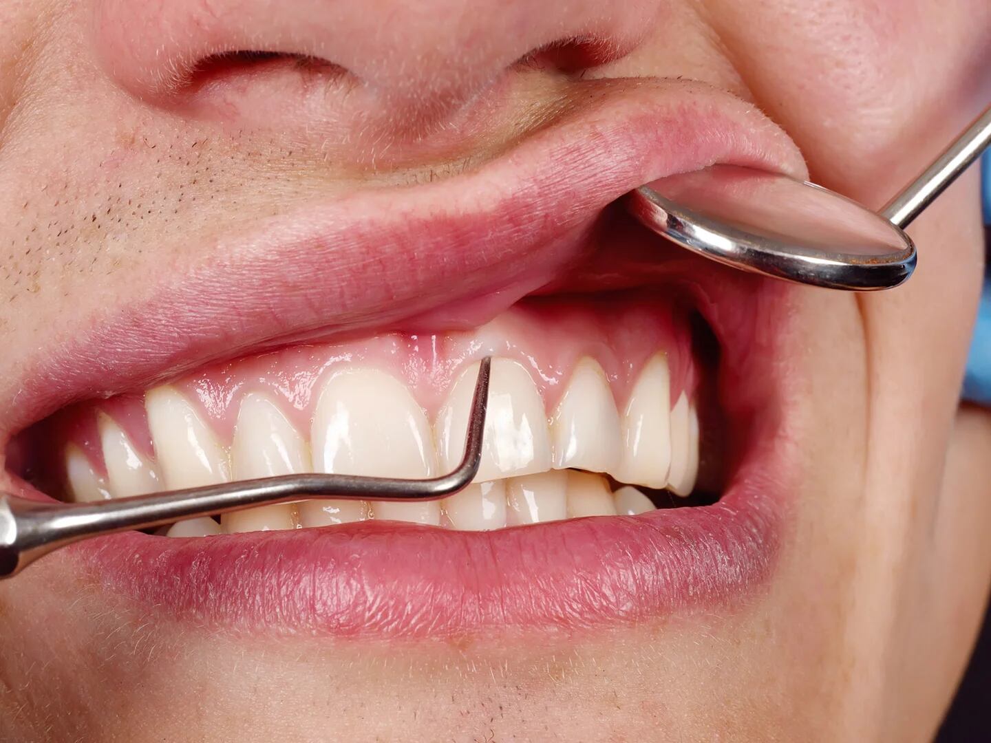 La importancia del hilo dental en la salud bucal - Zenit Odontólogos