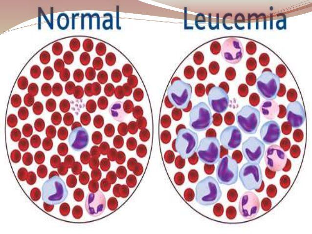 La Leucemia Mieloide Crónica afecta a unas 100.000 personas cada año en el mundo (Infobae)