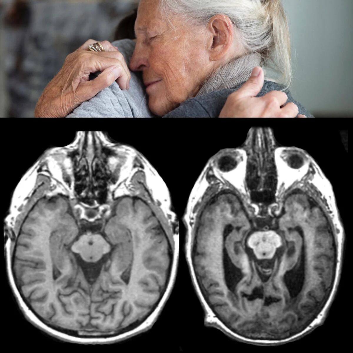 Cómo Tener Una Mejor Calidad De Vida Luego De Un Diagnóstico De Alzheimer Infobae 6941