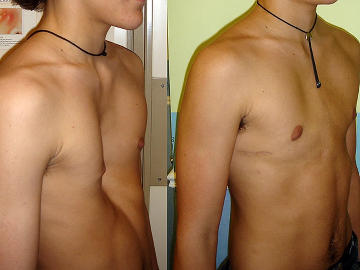 воронкообразная грудь у мужчин фото 32