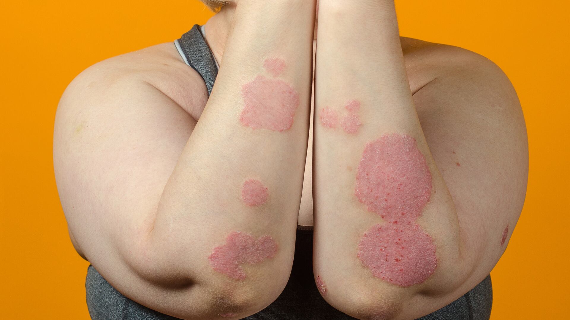 La psoriasis es una enfermedad autoinmune que puede variar desde casos asintomáticos hasta situaciones de discapacidad significativa - crédito Freepik