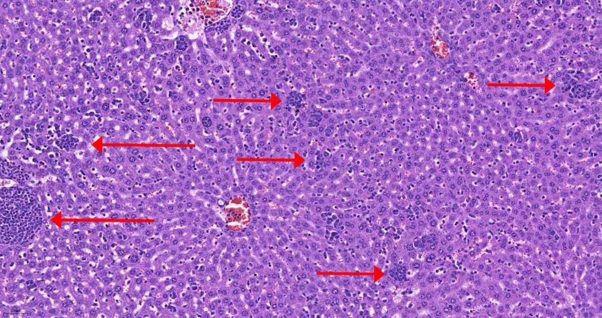 Tejido hepático de un ratón hembra con cáncer de mama. Las células del sistema inmunitario (grupos de células oscuras, marcadas con flechas) penetran en el hígado durante los primeros días de la aparición del tumor (Instituto Weizmann)