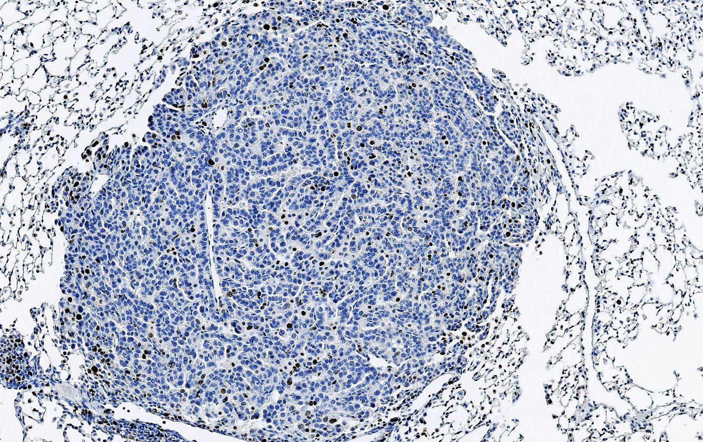 Lung tumor stained for proliferating cells (brown)  CREDIT IRB Barcelona