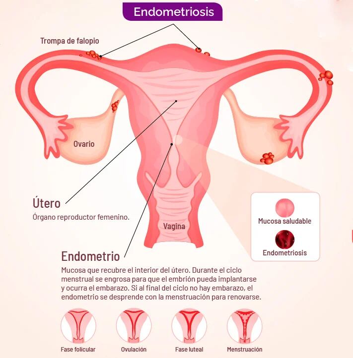 La endometriosis es una enfermedad inflamatoria, crónica, que se provoca por el crecimiento el endometrio fuera del útero, causando fuertes dolores durante la menstruación . Foto: DGDC/UNAM