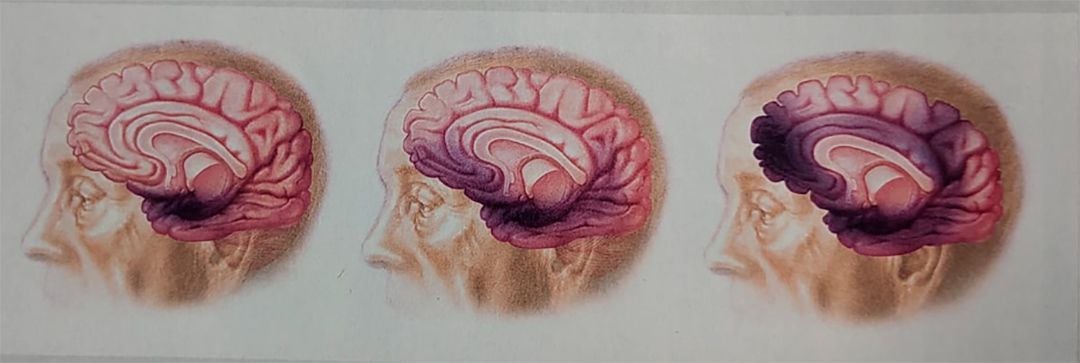 De izquierda a derecha, la progresión de la enfermedad de Alzheimer se ve en las zonas color bordó: leve, moderada y grave
(Mayo Clinic. Revista “Understanding Alzheimer’s - Your Guide to Brain Health”, publicada en Estados Unidos)