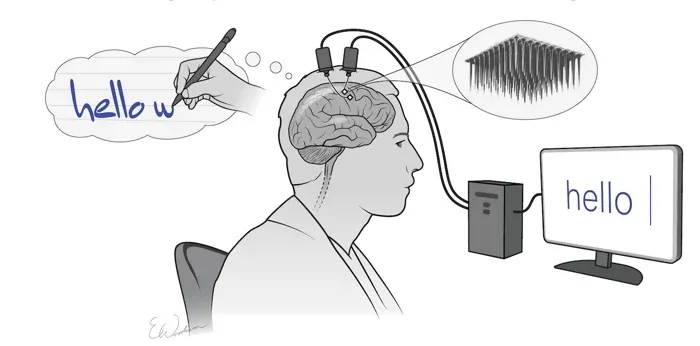 Um implante cerebral consegue traduzir os pensamentos de um homem paralisado com 94% de precisão