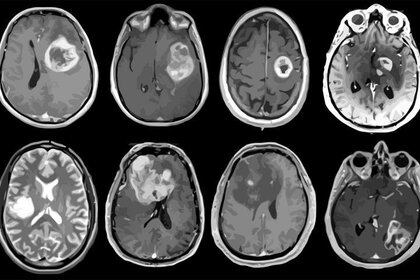 10/02/2021 Glioblastoma, tumor cerebral agresivo mapeado en detalle genético y molecular.
SALUD
ALBERT H. KIM
