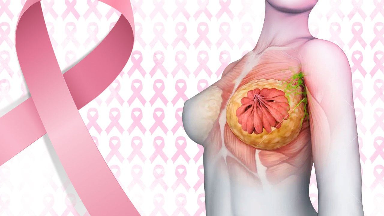 Día Mundial Del Cáncer De Mama Cuáles Son Los Síntomas Y Cómo Prevenirlo Infobae 5550