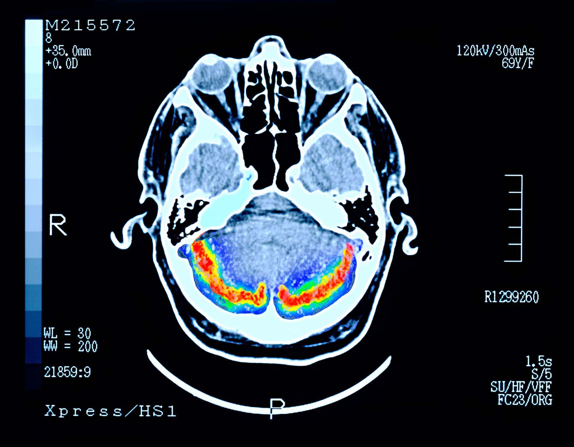 Hospital Santa Rosa Conmemora el Día Mundial del Alzheimer con evento de  estimulación cognitiva - Noticias - Hospital Santa Rosa - Plataforma del  Estado Peruano