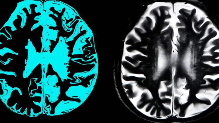 Una muestra de la manifestación del Alzheimer en el cerebro humano. (Getty)