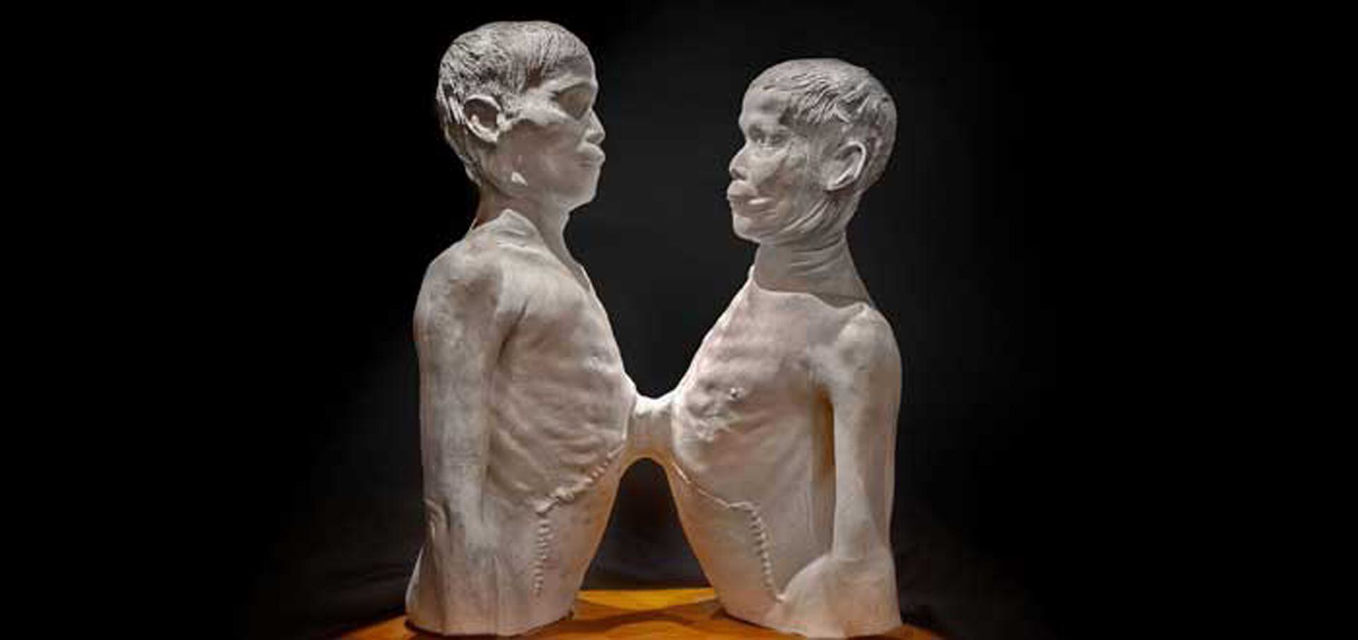 Chang y Eng, molde de yeso que les tomaron después de muertos y está en el Mütter Museum.