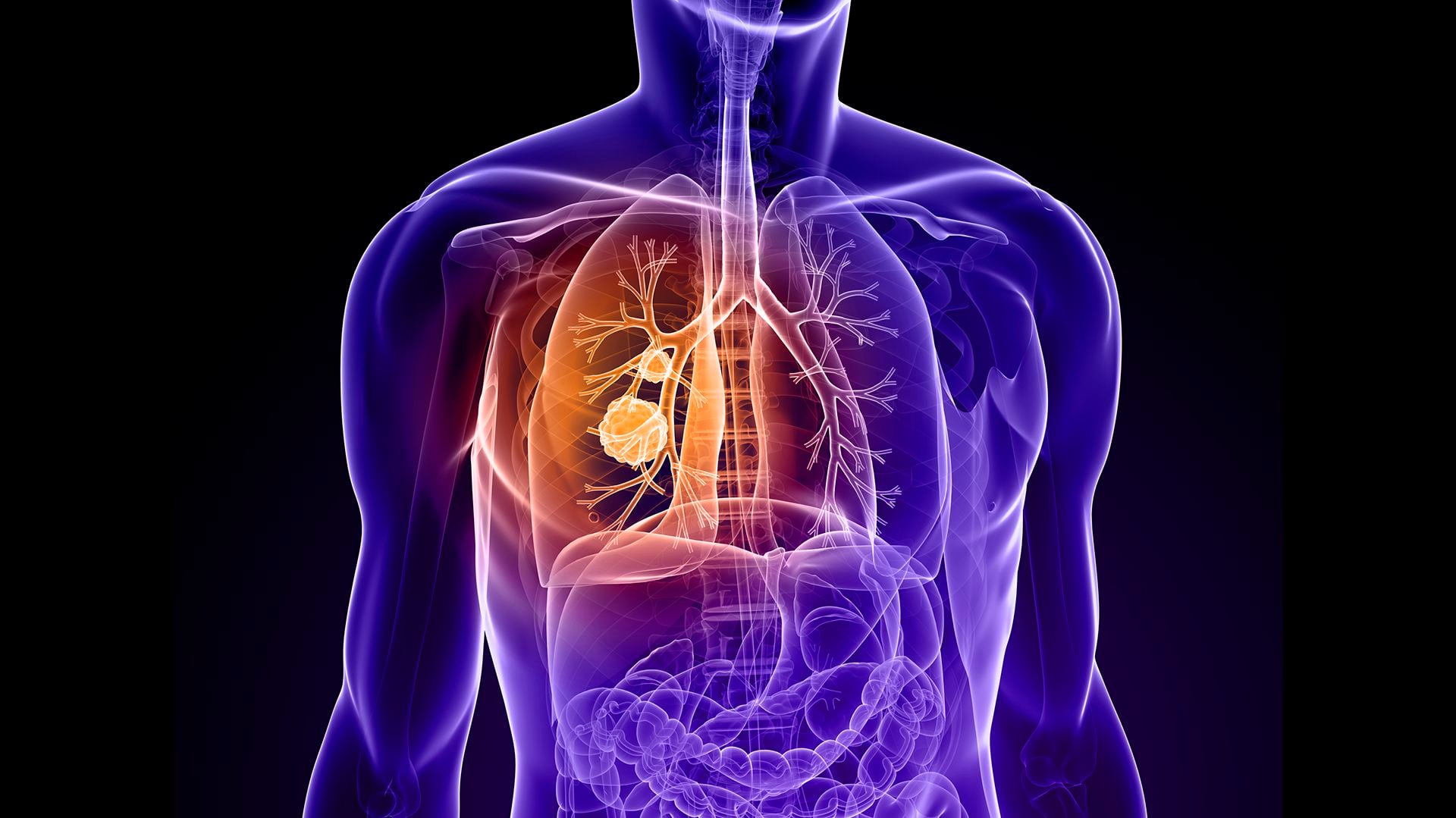 El catéter magnético se muestra prometedor ante la lucha contra el cáncer de pulmón, ofreciendo una alternativa más segura y efectiva para los pacientes
(IStock)