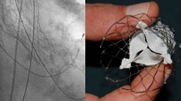 Ultimos Avances en Ciencia y Salud - Página 14 Valvularpercutaneocorevalve33