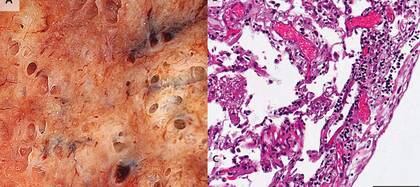 La inflamación del COVID-19 en los pulmones a simple vista (A) y en un examen celular bajo el microscopio (B), parte de la investigación que mostró cómo la trombosis afecta a los pacientes de coronavirus más que a los de la gripe. (NEJM)