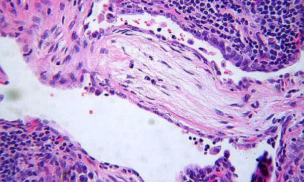 Bronquiolitis observada en tejido pulmonar bajo microscopio 