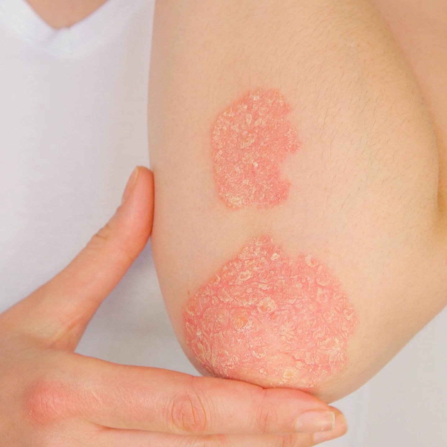 psoriasis entre los dedos