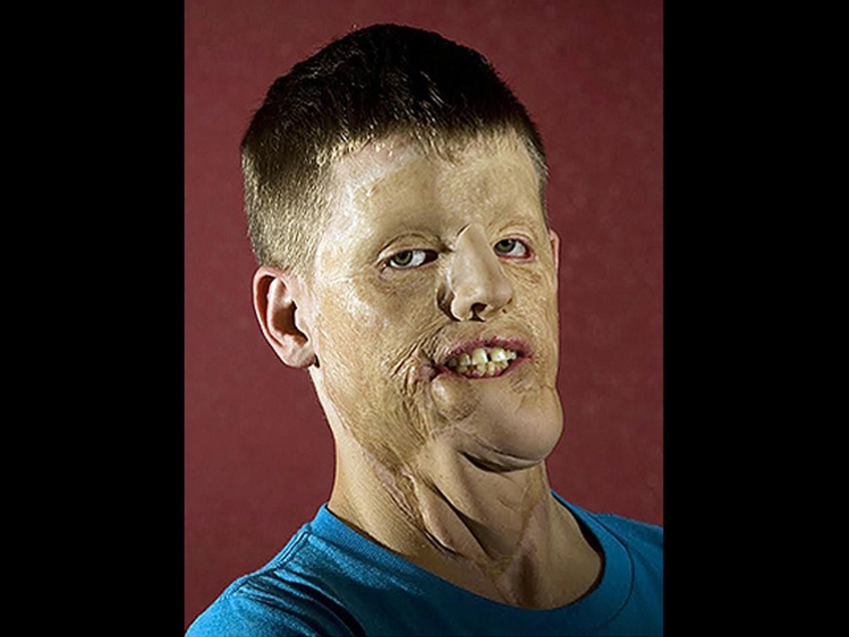 L'incroyable transformation d'un ancien soldat après l'une des premières greffes du visage au monde