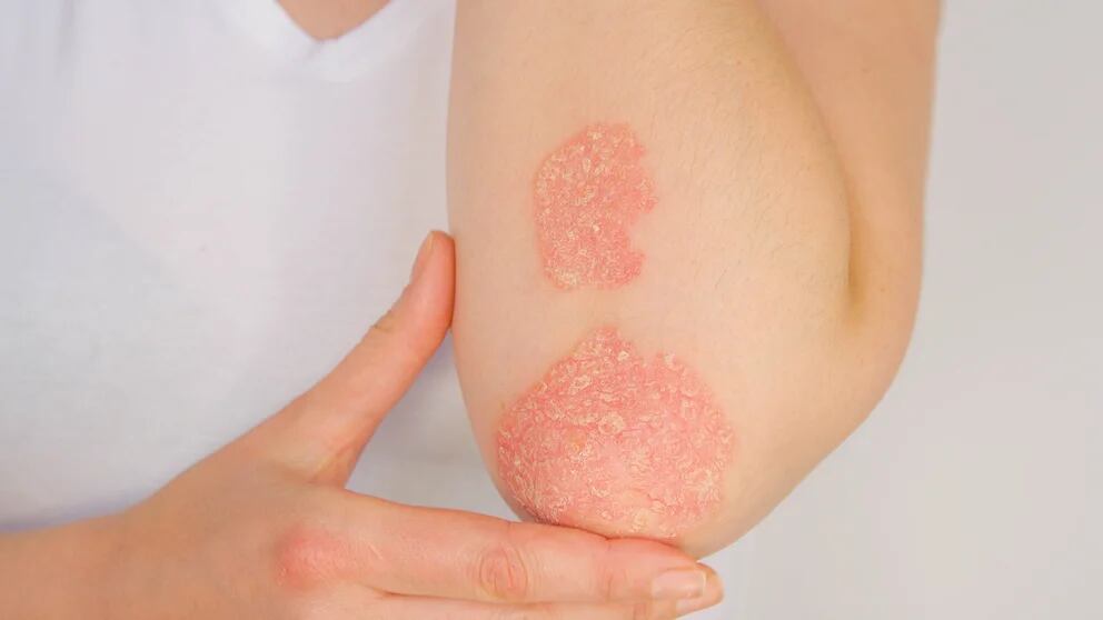 psoriasis entre los dedos