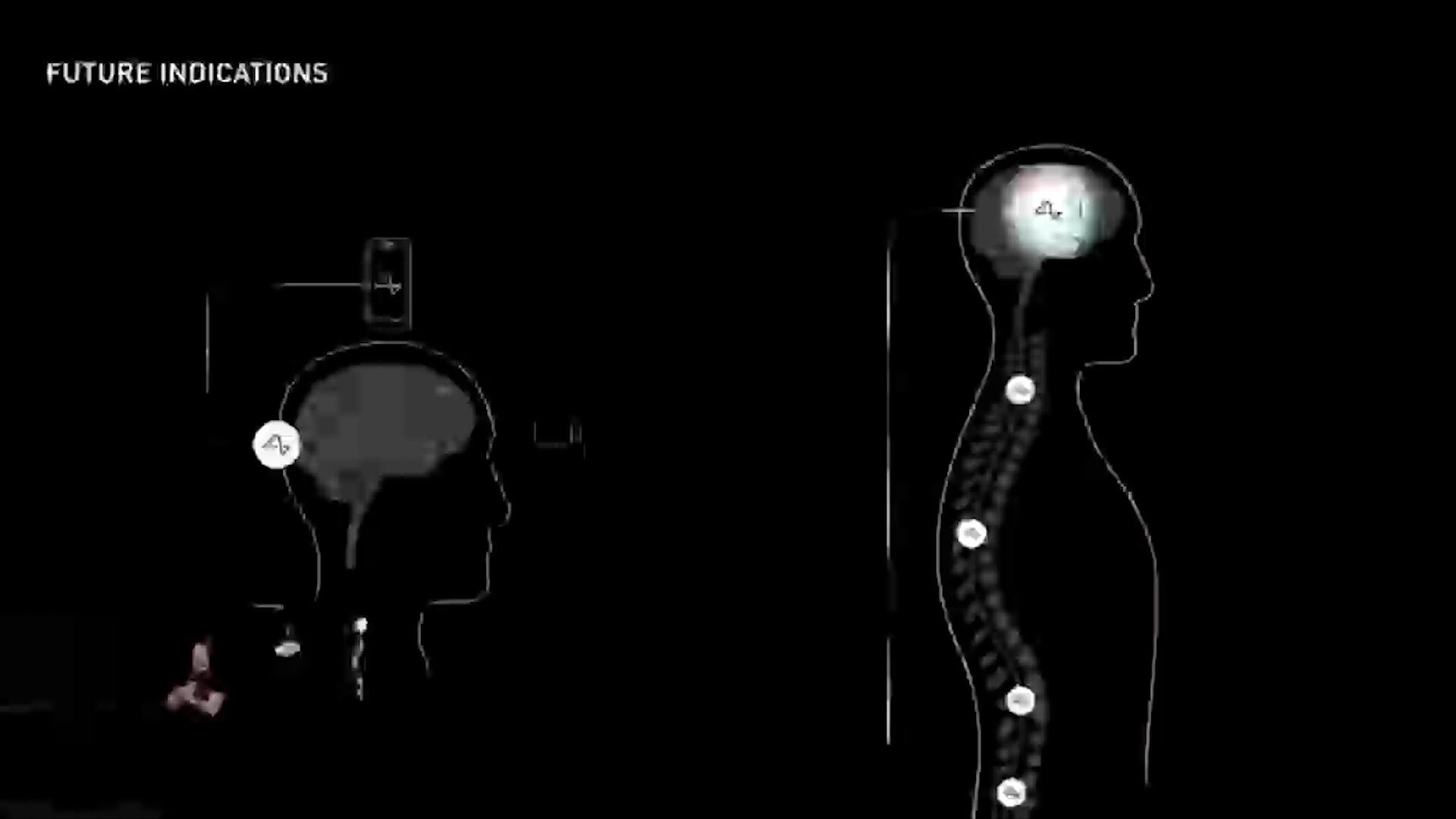 Elon Musk sorprende al mundo: Promete restaurar la vista con tecnología Neuralink captura