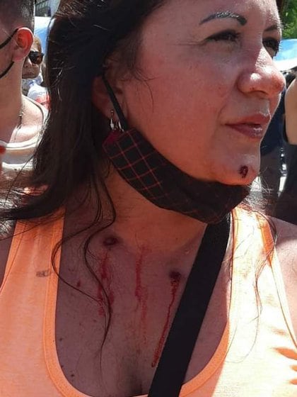 Una mujer recibió balazos de goma en su cuello y el rostro