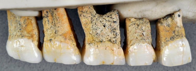 Dientes de Homo luzonensis (Callao Cave Archaeology Project)