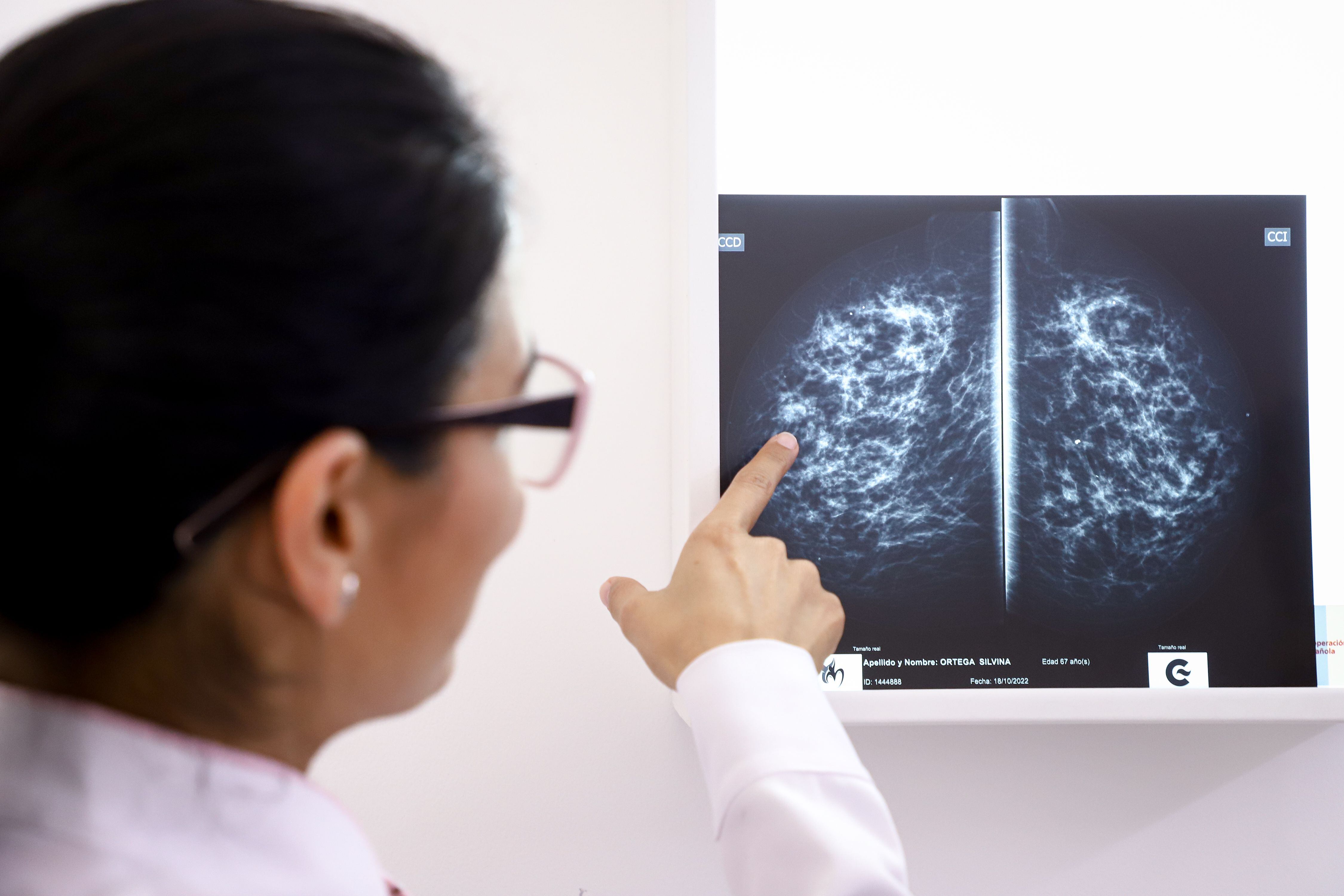 Una imagen de archivo de una doctora al observar una radiografía de diagnóstico de cáncer de mama. (EFE/Nathalia Aguilar)
