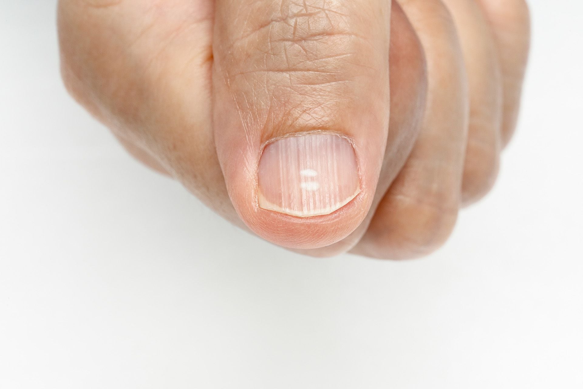 En la imagen: manchas blancas y crestas verticales en las uñas como posible síntomas deficiencia de vitaminas y minerales
Crédito: Freepik