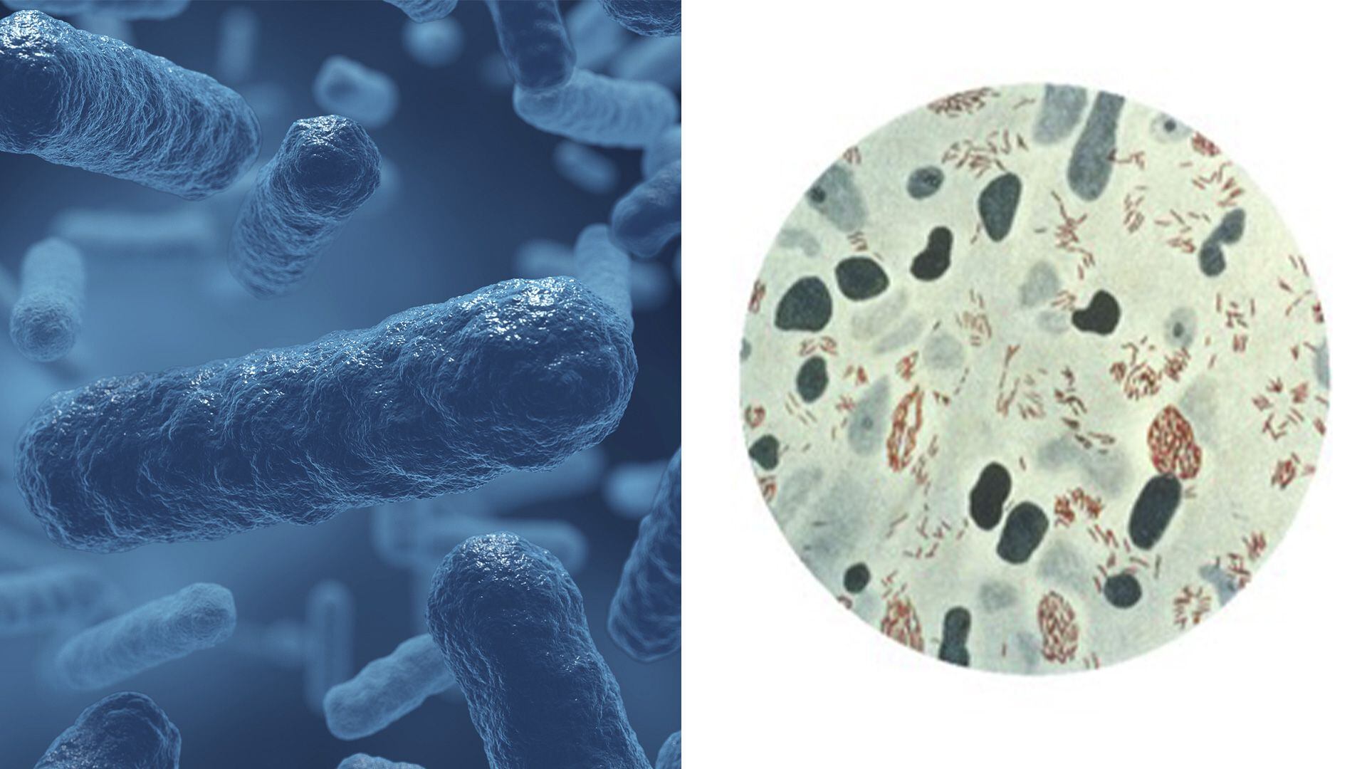 lepra y tuberculosis