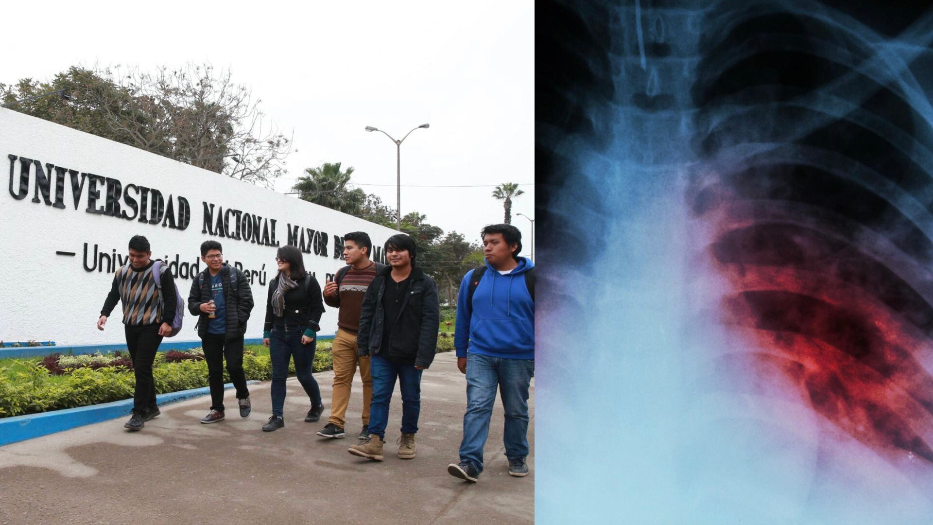 Descartan brote epidémico de tuberculosis en San Marcos.