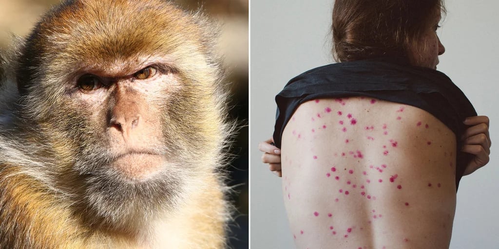 Viruela del mono en México: formas de contagio y tratamiento según la UNAM  - Infobae