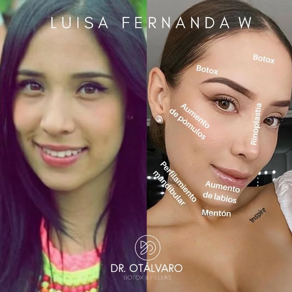 Fotos Del Antes Y El Después De Las Famosas Que Pasaron Por El Quirófano Infobae 