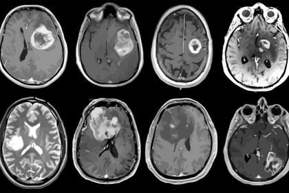 El glioblastoma se define como un ‘tumor frío’, lo que significa que no responde a intentos inmunoterapéuticos para activar el sistema inmunológico contra él
