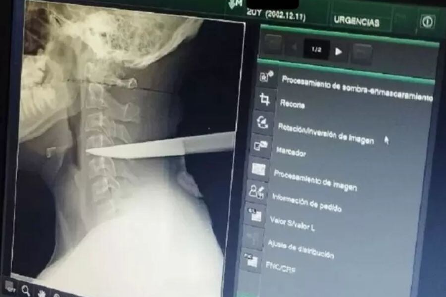 Sobrevivió con un cuchillo clavado en el cuello durante varias horas