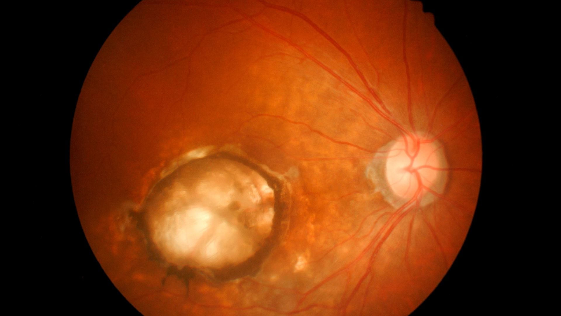 Degeneración Macular DMRE