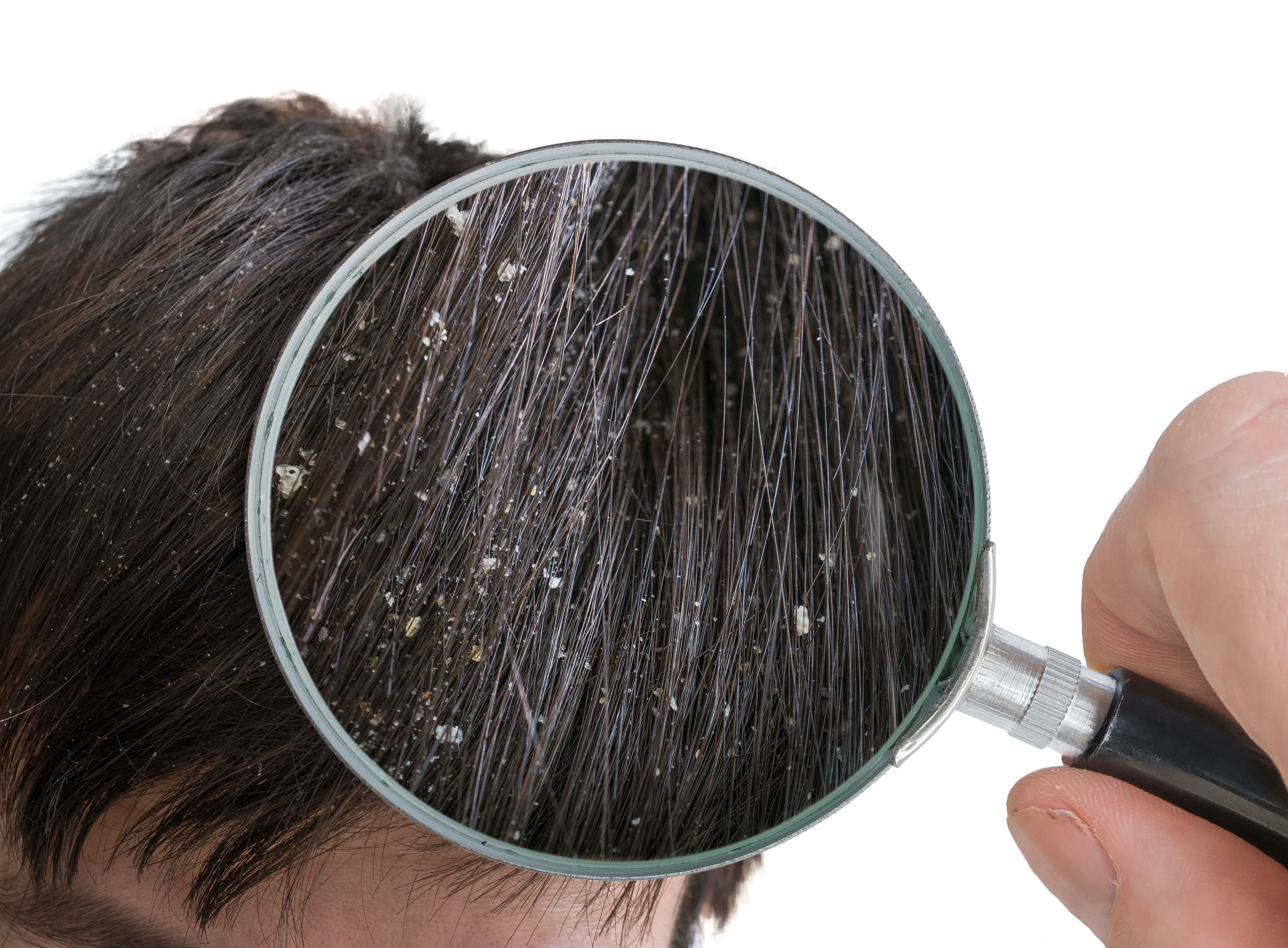 A pesar del mito, la caspa no es resultado de un cuero cabelludo seco, sino más bien de un cuero cabelludo oleoso o de la dermatitis seborreica 
