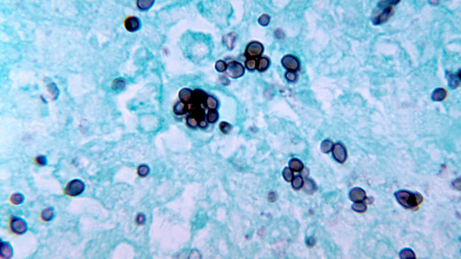 HISTOPLASMOSIS