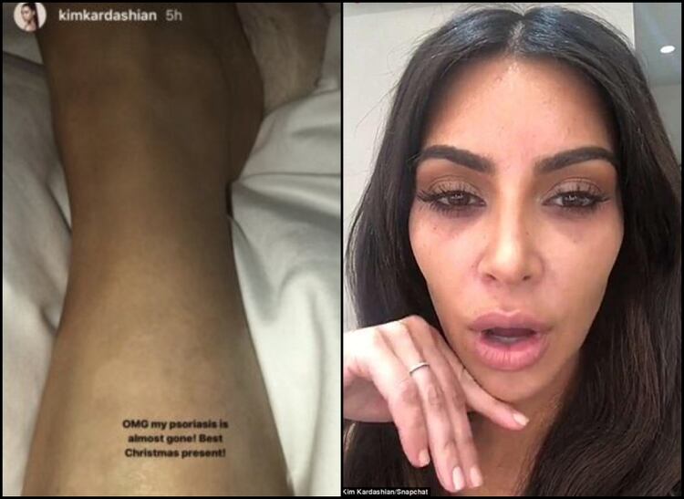 En Snapchat, Kim Kardashian lleva semanas mostrando su preocupación por la enfermedad que padece, y pregunta a los usuarios por tratamientos para aliviar la inflamación (Foto: Snapchat @KimKardashian)