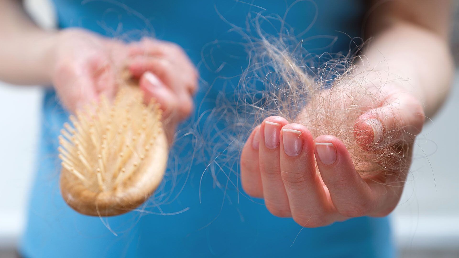 alopecia caida del cabello