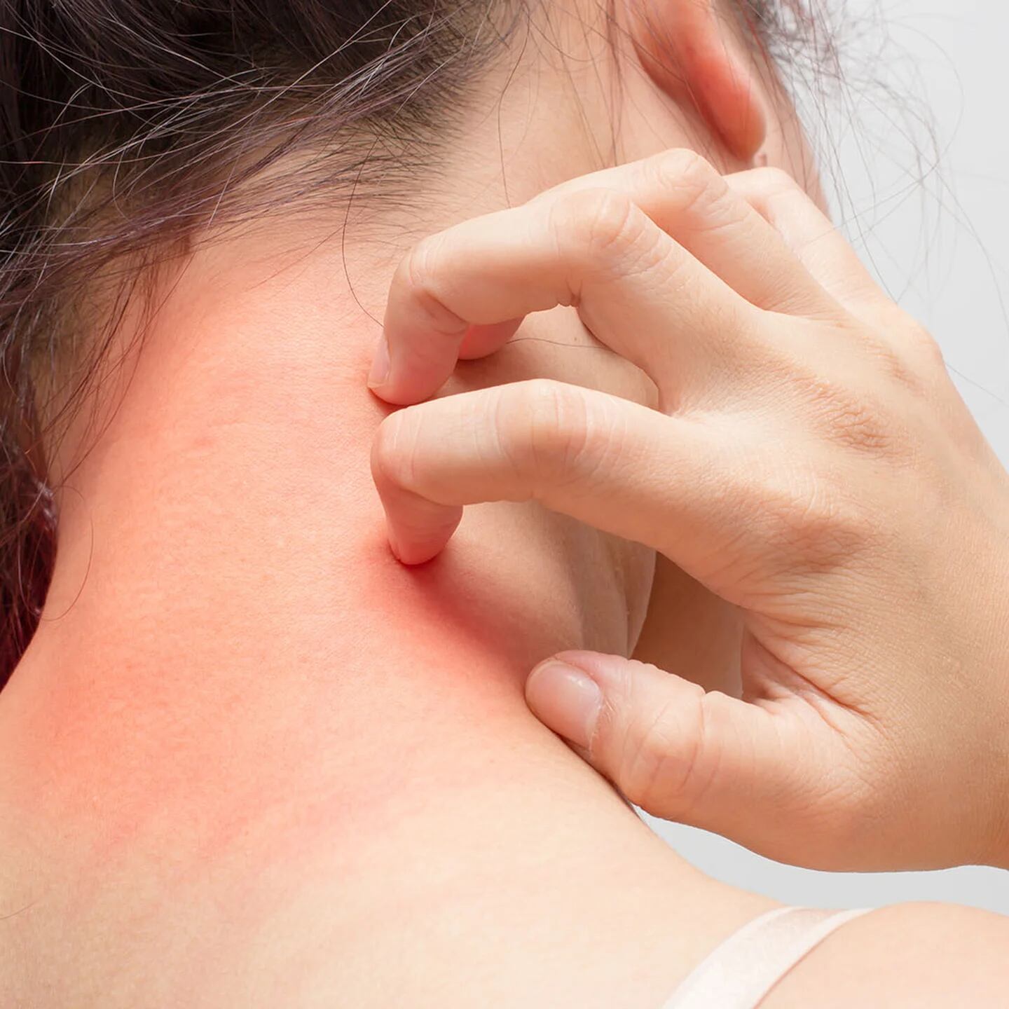 Cuáles son los beneficios y los riesgos de la fototerapia para la  dermatitis atópica?