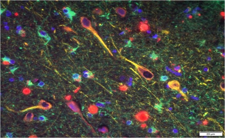En color rojo, las bacterias P. gingivalis en el tejido cerebral de una persona que murió por Alzheimer. (Cortexyme)
