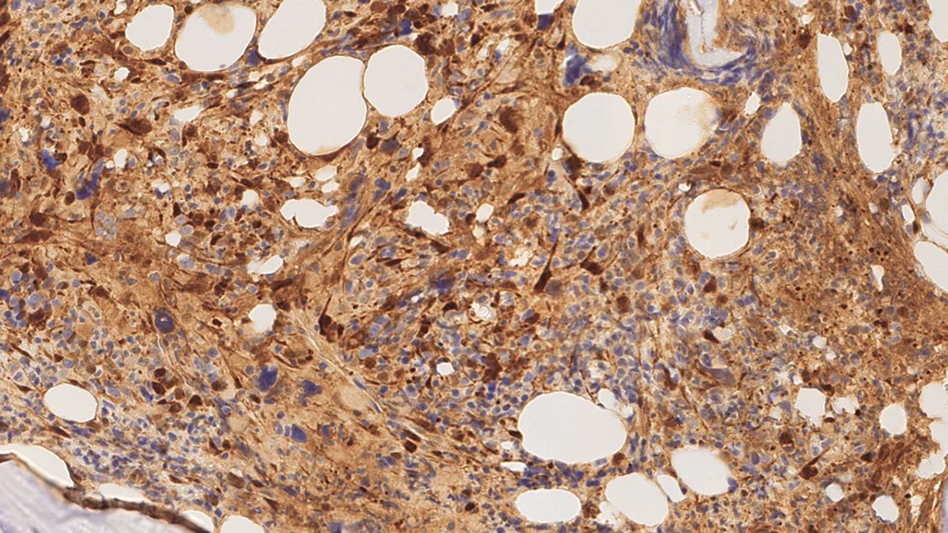 Una biopsia de médula ósea que muestra la expresión densa de galectina-1 en la mielofibrosis. La imagen fue capturada por los investigadores / Crédito: Profesor Daniel Royston, Universidad de Oxford.