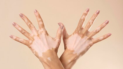 Qué es el vitiligo, cuáles son sus síntomas y cómo se trata