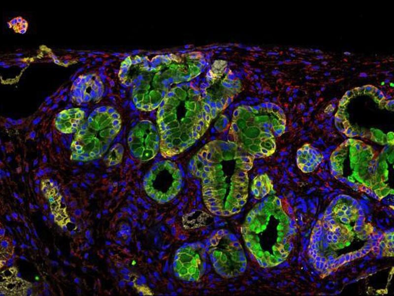 Administrar quimioterapia a las personas con cáncer de páncreas antes y después de una cirugía para extirpar el tumor produjo mejores resultados (Bruno Sainz/CSIC) 