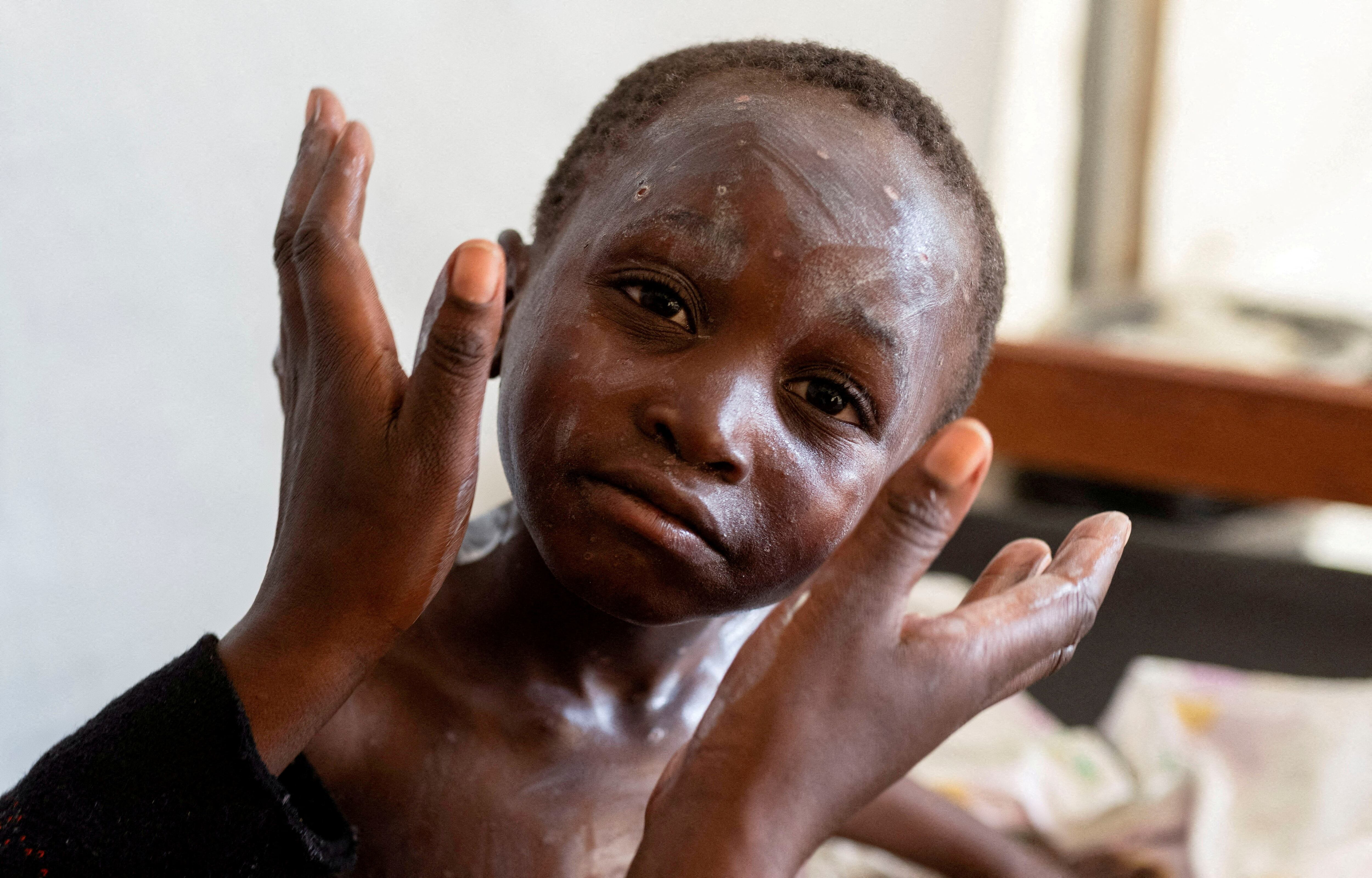 "La mayoría de los casos de Clado I en la Repúlbica del Congo se dan en niños y adolescentes menores de 15 años, y el modo de transmisión parece ser a través del contacto directo”, detalló el doctor Daniel Kuritzkes, profesor en la Facultad de Medicina de Harvard (REUTERS)