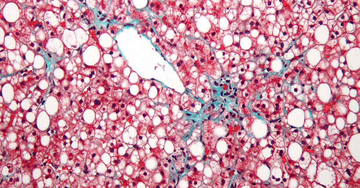 A micrograph of an inflamed fatty liver. White indicates areas of fat; red are hepatocytes or liver cells. Bluish areas are fibrotic strands.

CREDIT
Nephron

U