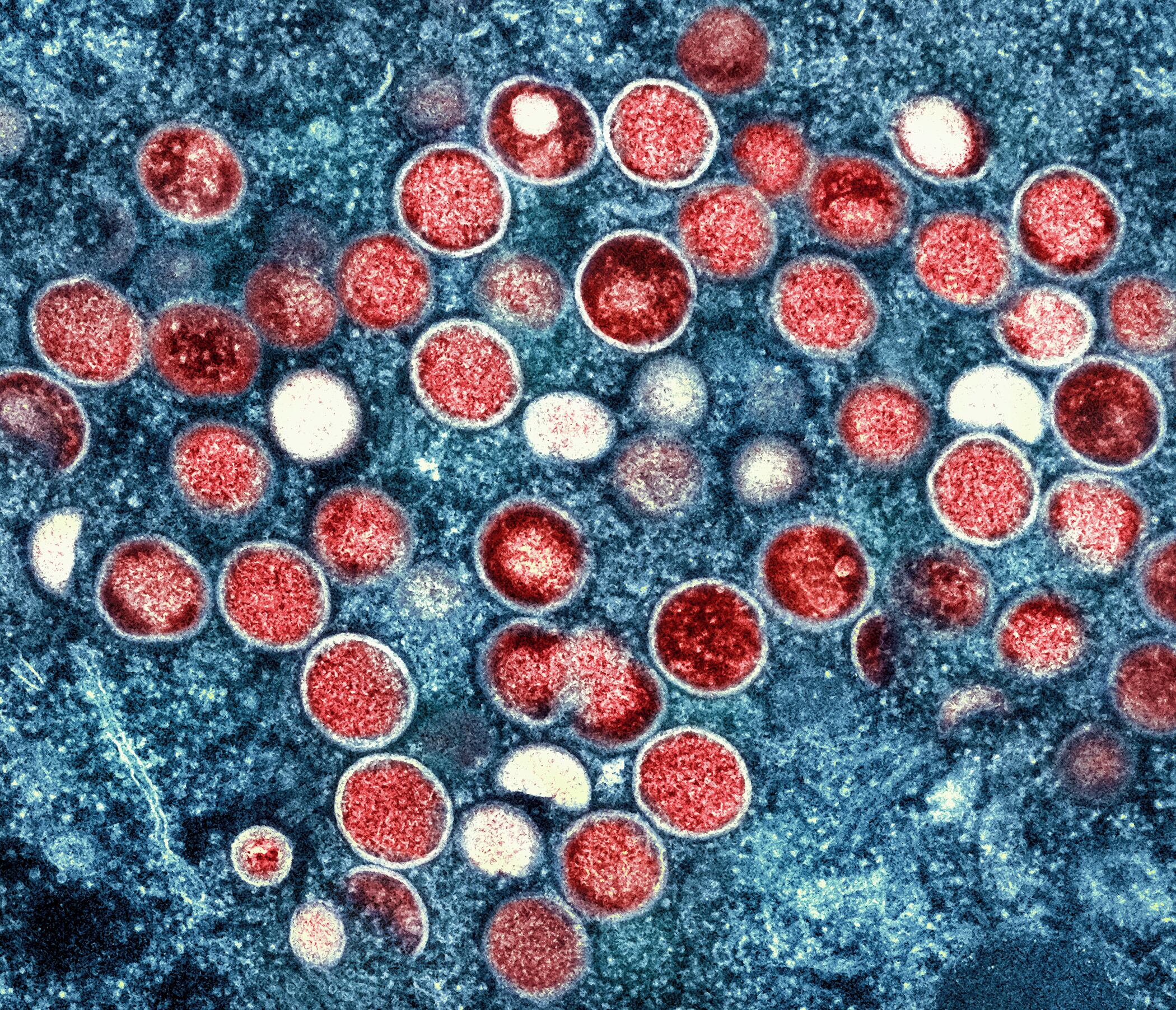 Mpox es una enfermedad viral. Es causada por el virus del mismo nombre, una especie del género Orthopoxvirus. Existen dos clados diferentes: clado I y clado II (NIAID vía AP, Archivo).