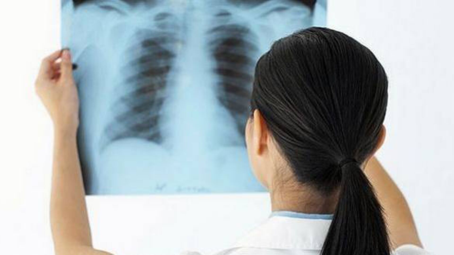 La detección de la FPI requiere un enfoque multidisciplinario con especialistas en neumonología, radiología y patología para lograr un diagnóstico certero (iStock)